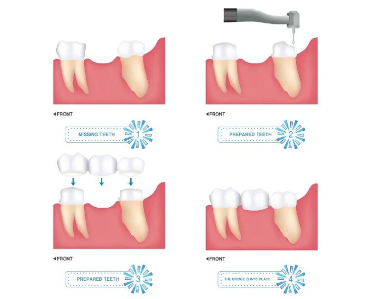 Dental Bridges Illustration