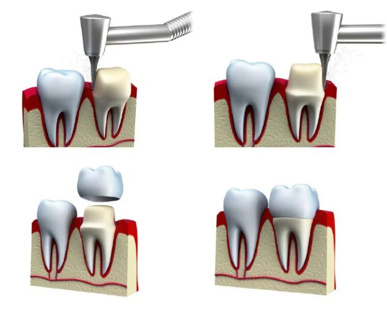 Dental Crown Step-by-Step Illustration