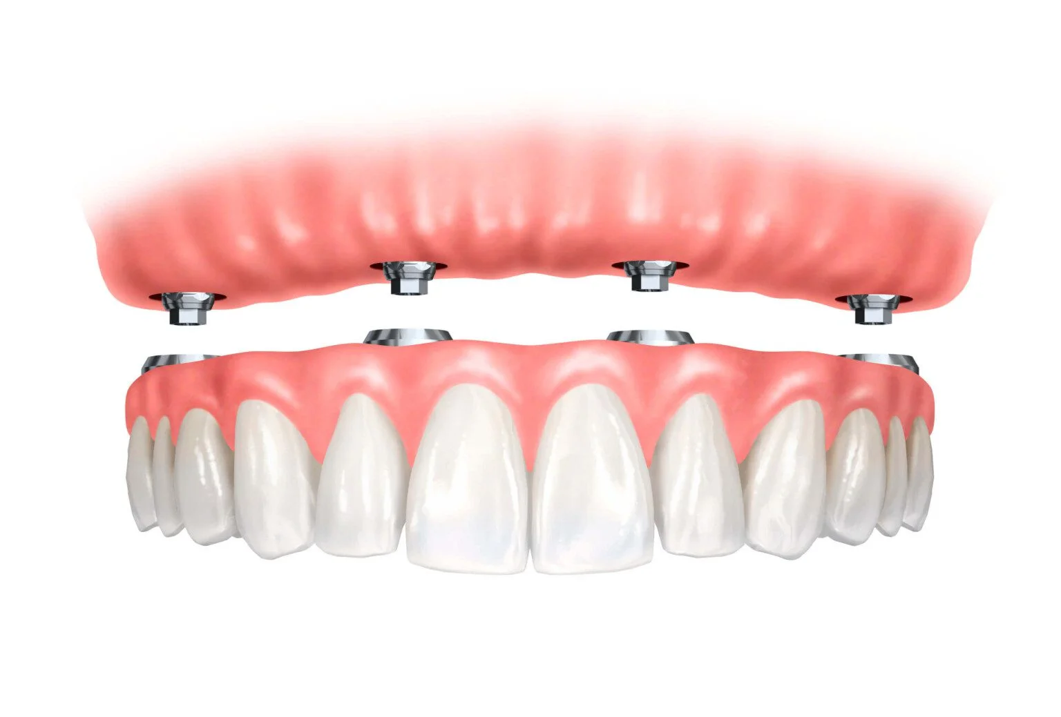 Implant Supported Fixed Dentures