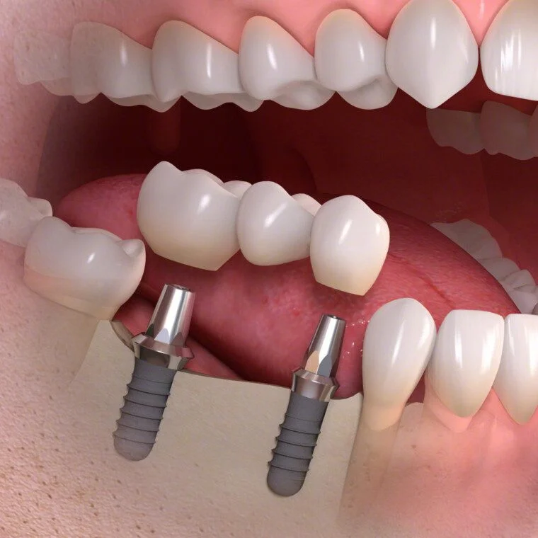 Multiple tooth implant
