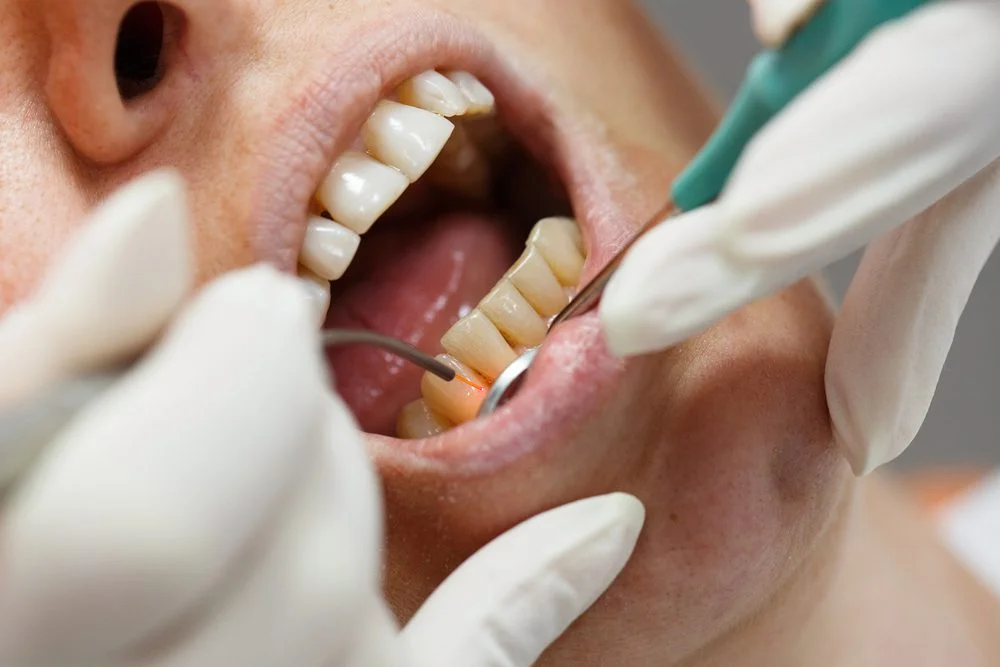 laser-dentistry-treatment-Indirapuram-Ghaziabad-painless-gum-treatment-Aryas-Dental-Niti-Khand