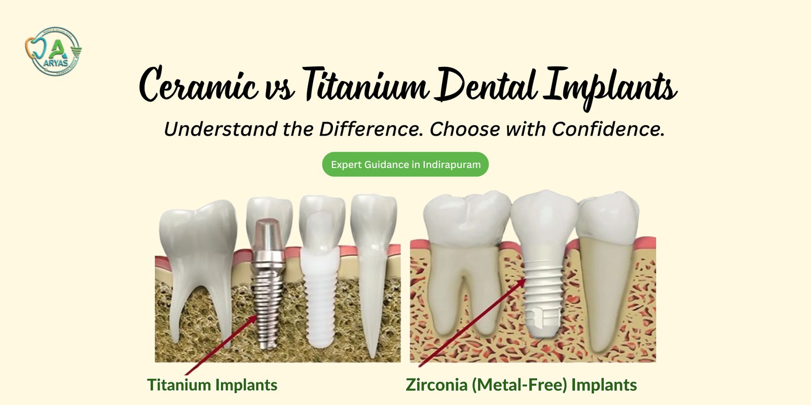 ceramic-vs-titanium-dental-implants-comparison-indirapuram-clinic-guide