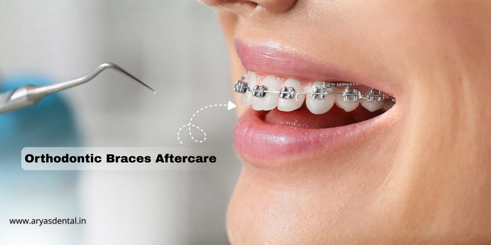 braces-aftercare-indirapuram-aryas-dental-orthodontic-treatment-guide
