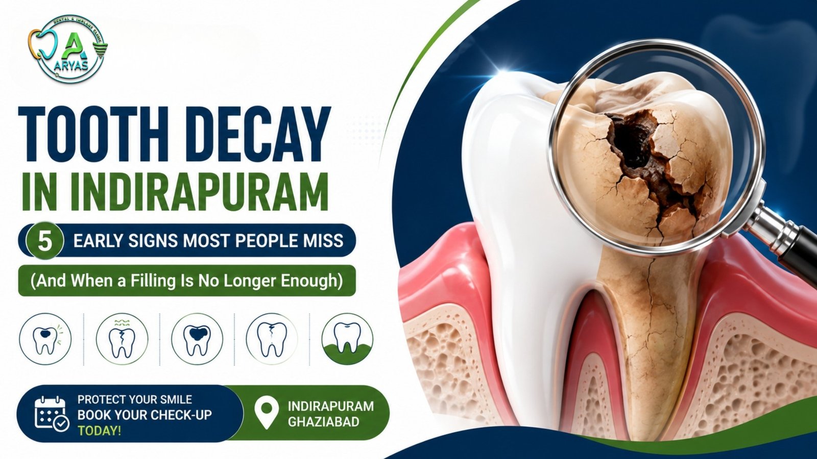 Tooth Decay Signs in Indirapuram | Filling vs RCT vs Implant