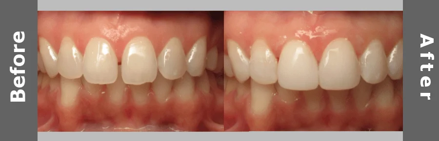 Stained and Whitened Teeth Comparison