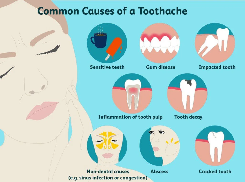 Root canal treatment illustration