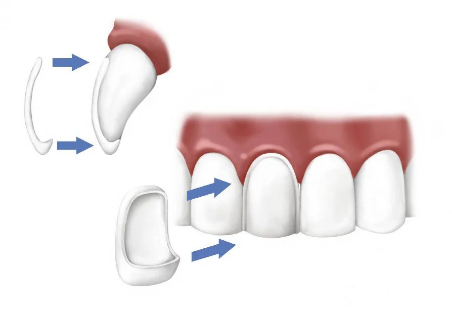 Porcelain Veneer Process