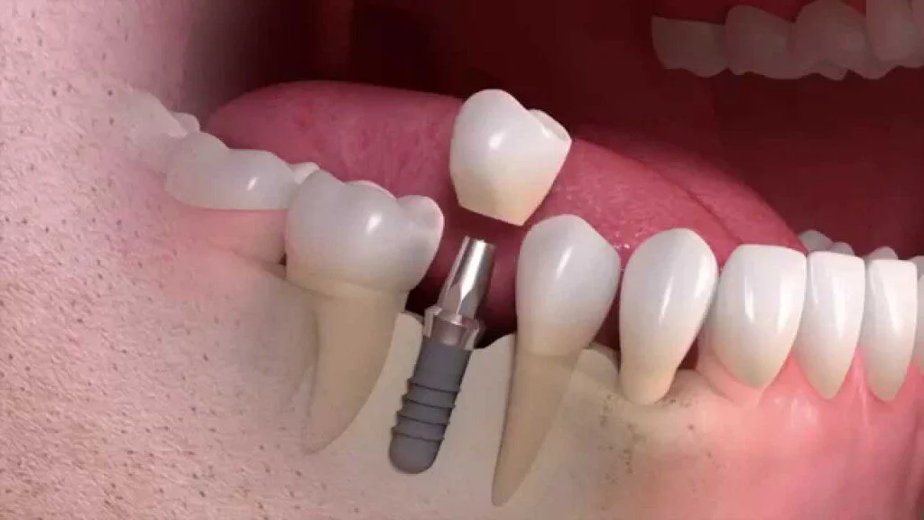 Single tooth implant