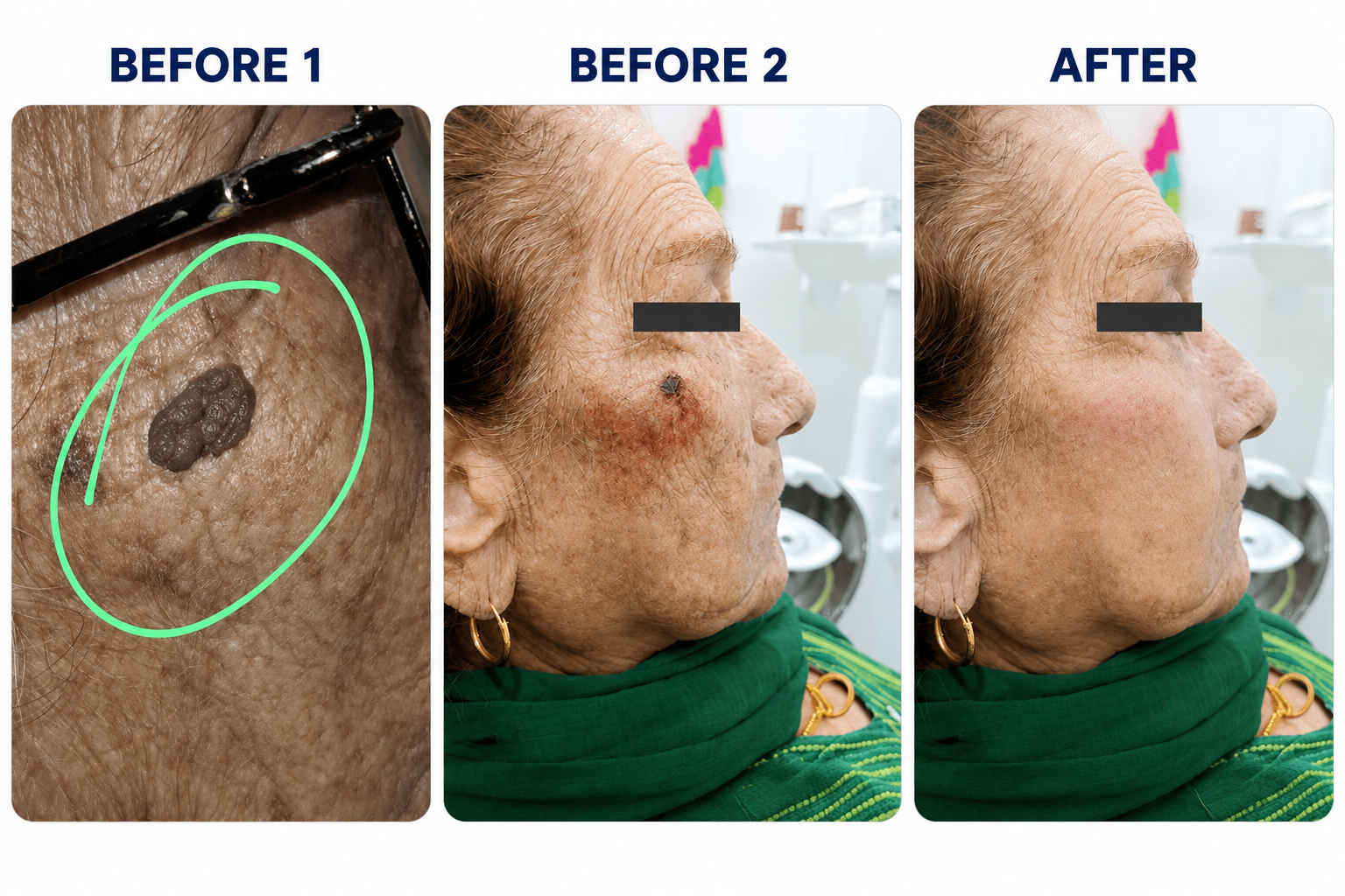 mole-removal-treatment-Indirapuram-Ghaziabad-Aryas-Dental-Implant-Clinic-Niti-Khand-2-skin