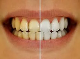 Stained and Whitened Teeth Comparison