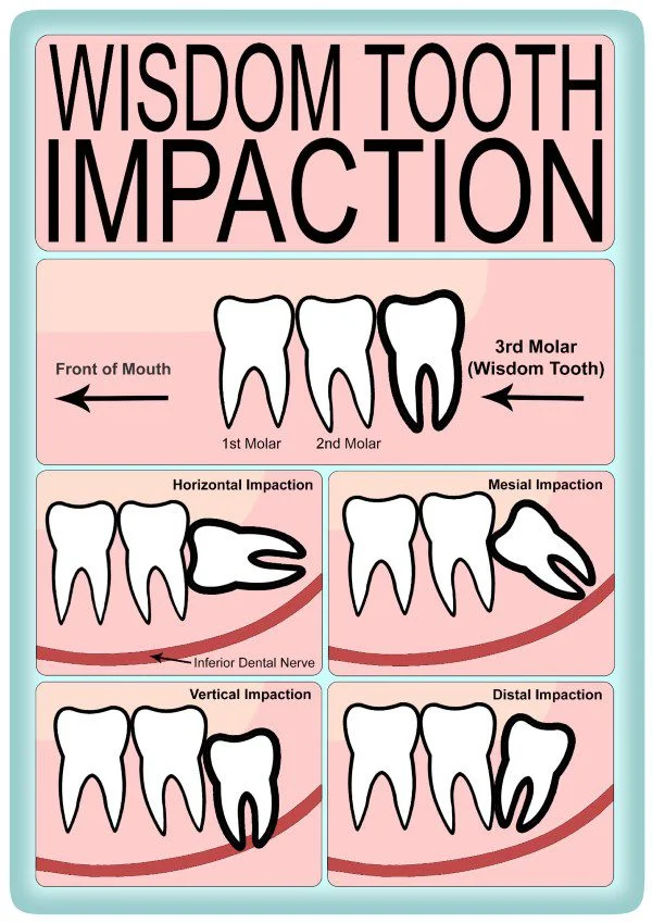 Wisdom Tooth Impaction